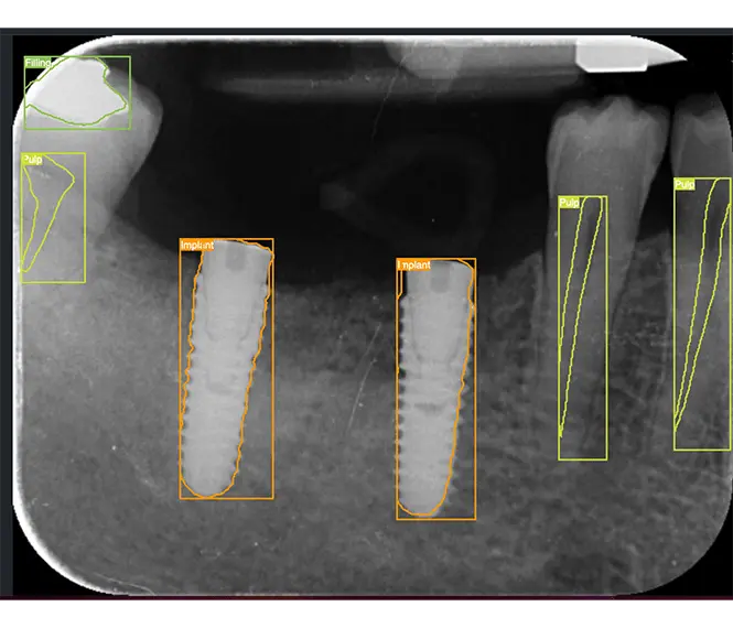 Dental Implants